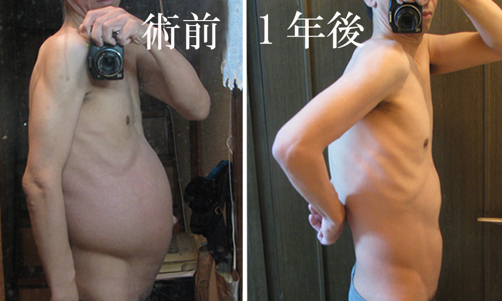 腎動脈塞栓術TAE　比較写真データー。
