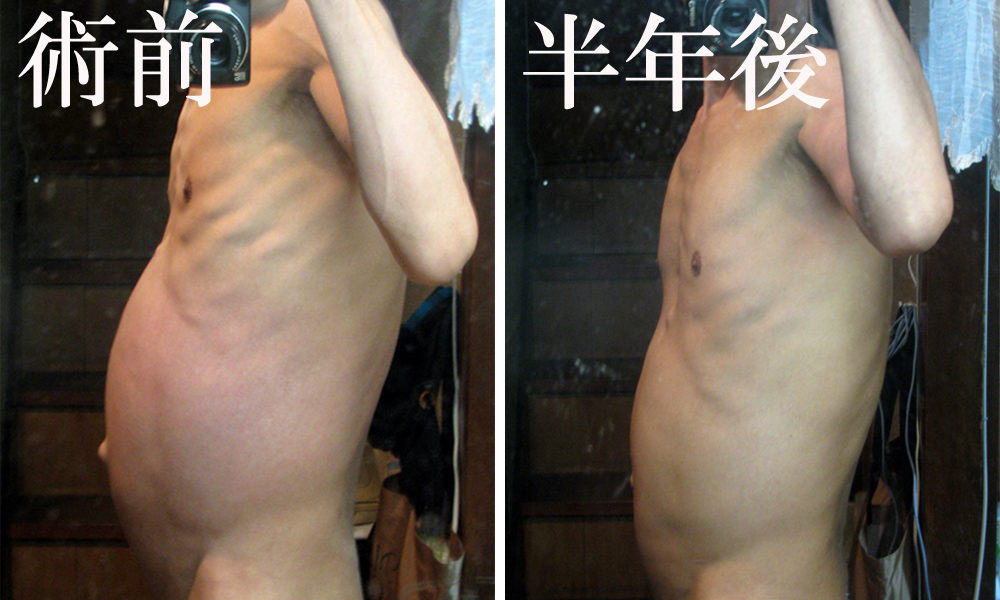 多発性嚢胞腎、手術の比較データー